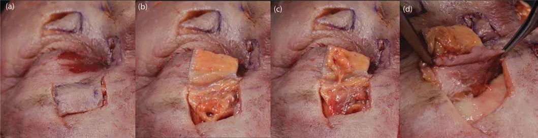 Fig 2. Plane-by-plane dissection of the supraorbital region, four panels